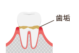 歯垢がたまるイラスト