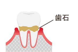 歯石ができるイラスト