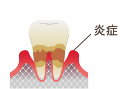 歯茎が炎症するイラスト