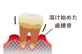 歯槽骨が溶けるイラスト