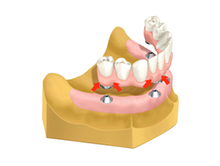 当院では、奥のインプラントを骨のある部分へ斜めに埋め込み力を均等に配分し、最小4本のインプラントで全ての人工の歯を支える最先端のインプラント治療法All-on-4を採用しています。手術や費用の負担を必要最低限に抑えられます。