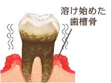 歯茎が炎症で歯槽骨が溶け始め、歯がグラグラになり抜け落ちます。これが歯周病です。